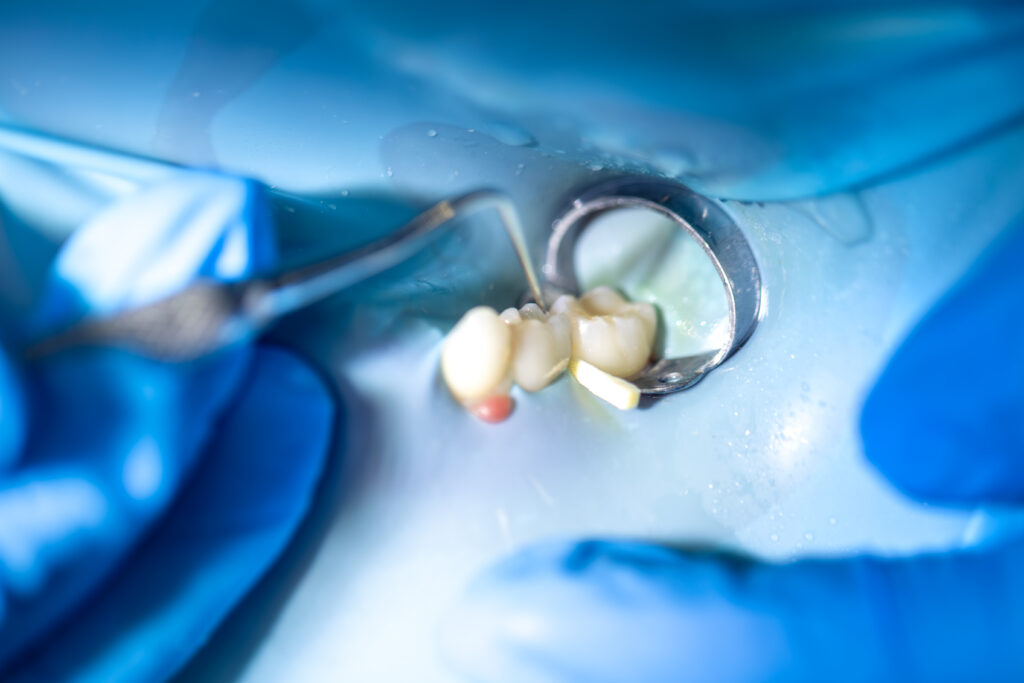 Application of dental fissure sealants for cavity prevention