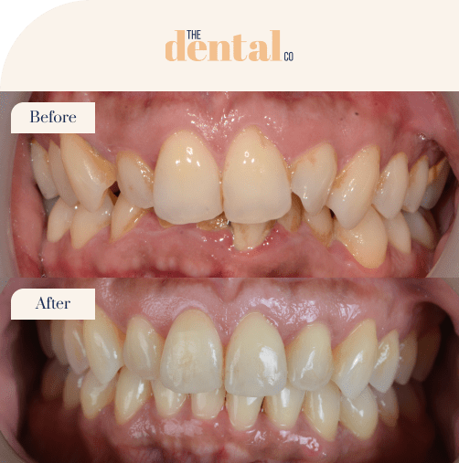 before and after image of a patient teeth