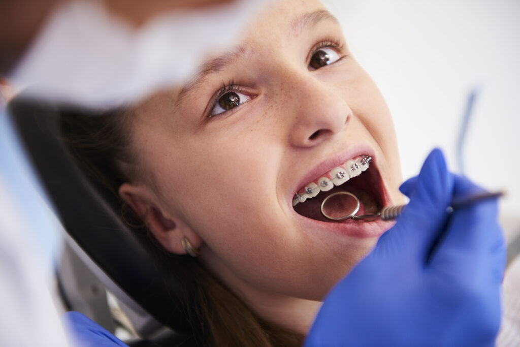 Children’s dental braces for orthodontic treatment
