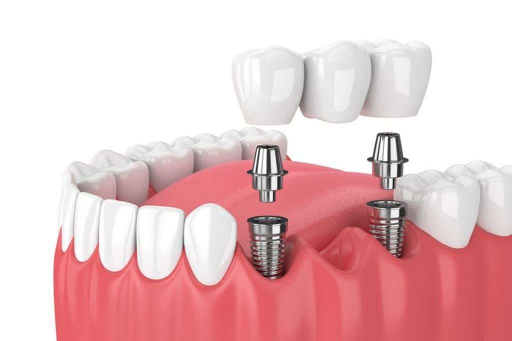 Multiple tooth dental implant on jaw model